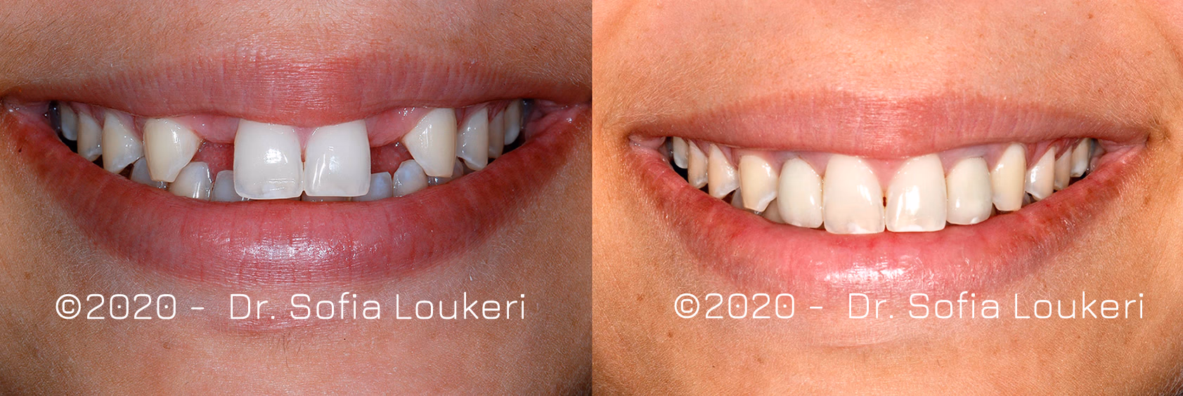 Dental implant restorative case