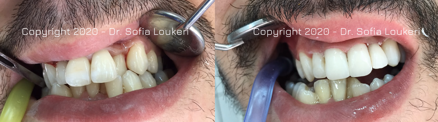 Full-mouth restorative dental case
