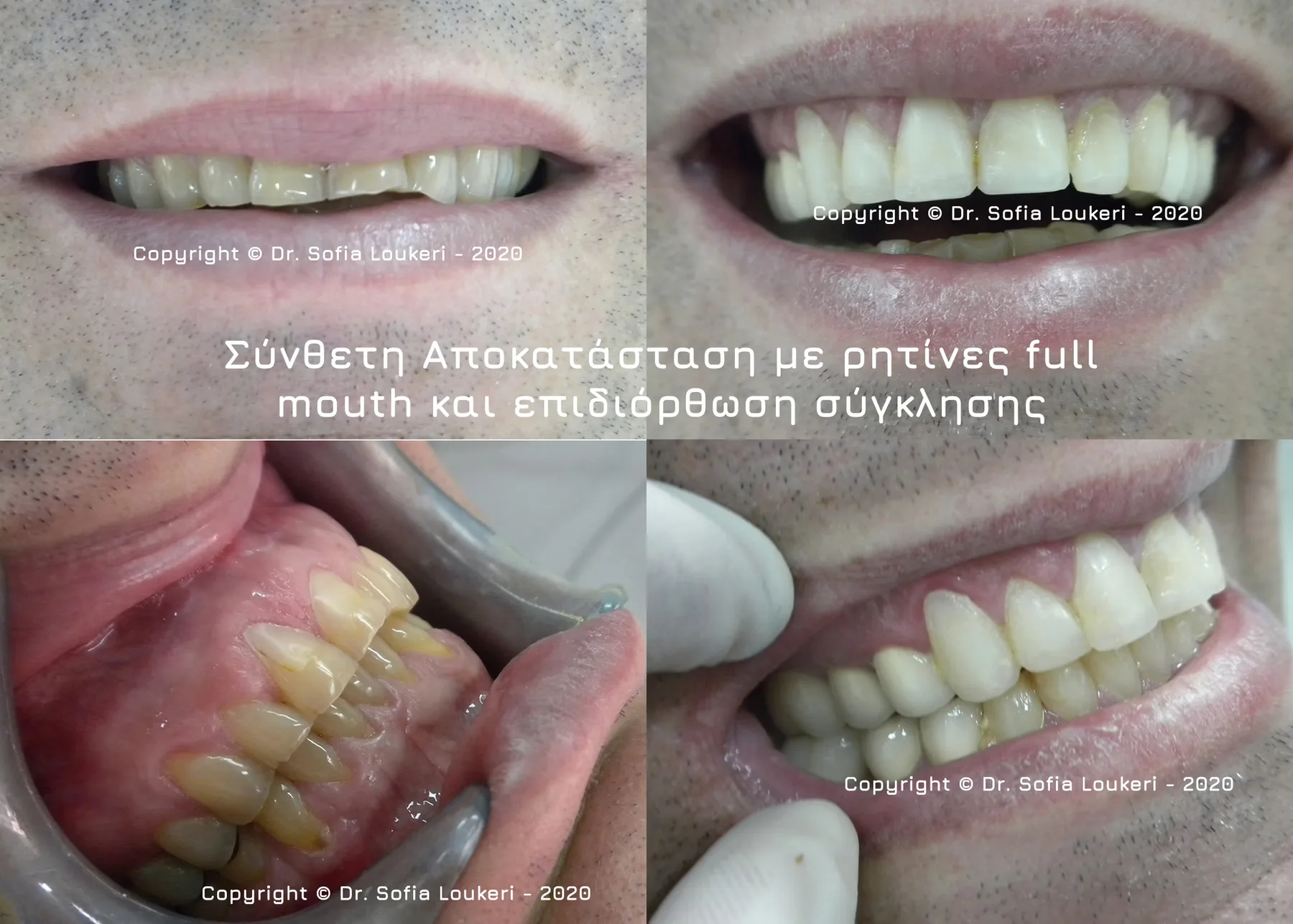 Κλινική εικόνα όψεων ρητίνης