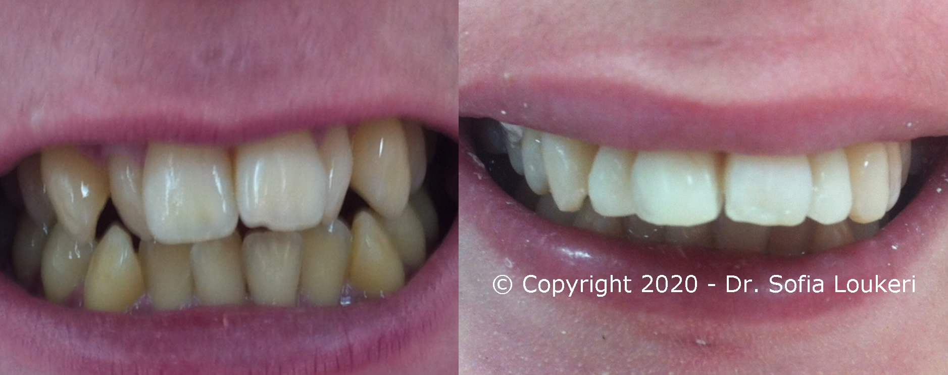 Natural aesthetic dental case